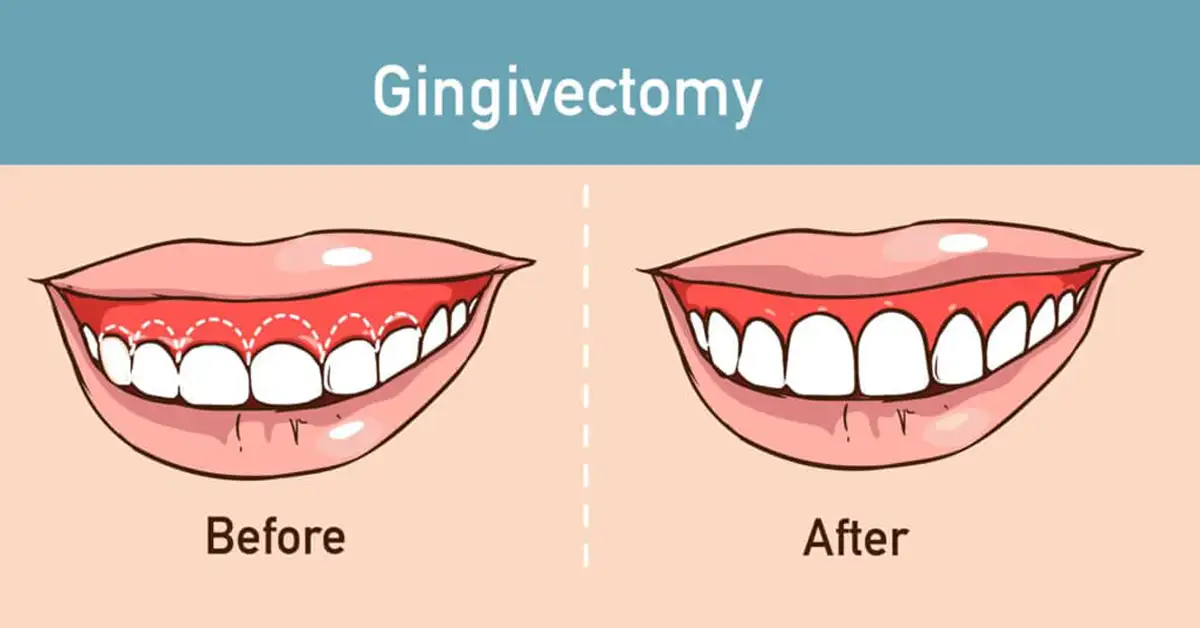 5 Fakta Penting Tentang Gum Lifting yang Perlu Kamu Tahu