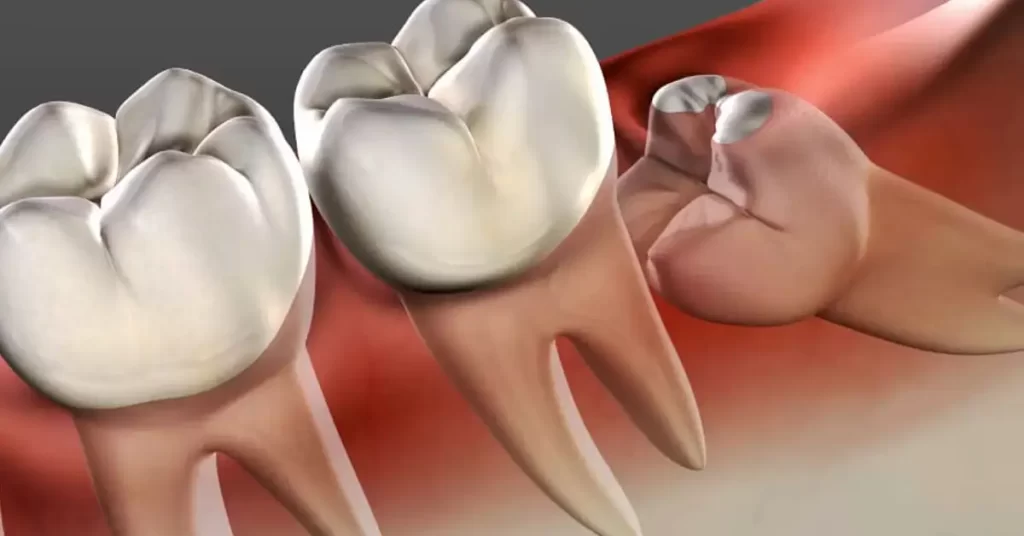 Operasi Gigi Bungsu (Odontektomi): Prosedur, Biaya, dan Pemulihan