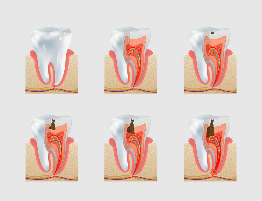 Tambal Gigi Implan Gigi Tars Dental Care