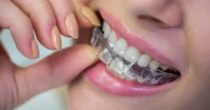 5 Perbedaan Aligner Gigi dan Retainer Gigi Dalam Merapikan Gigi
