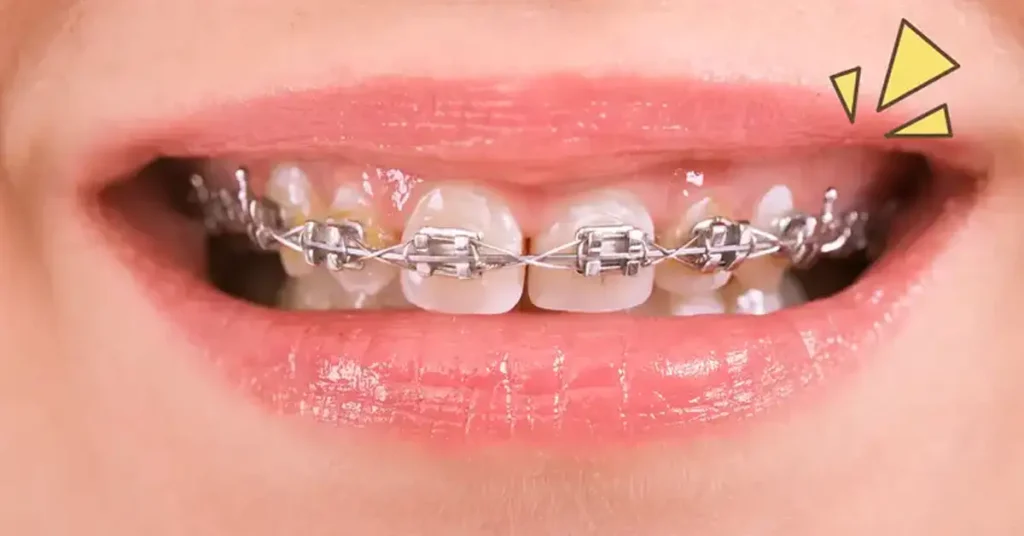 Behel Gigi: Panduan Lengkap untuk Kamu yang Ingin Merapikan Gigi