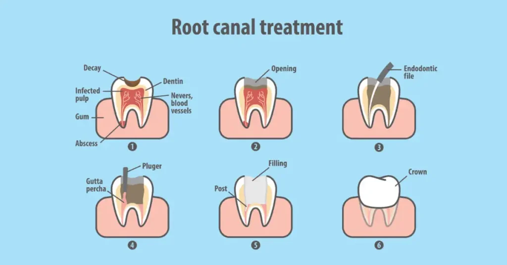 Perawatan Saluran Akar Gigi atau Root Canal Treatment