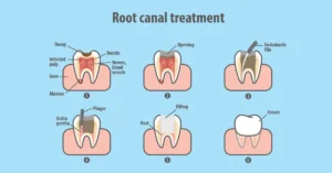 Perawatan Saluran Akar Gigi (Root Canal Treatment): Panduan Lengkap untuk Pasien Pemula