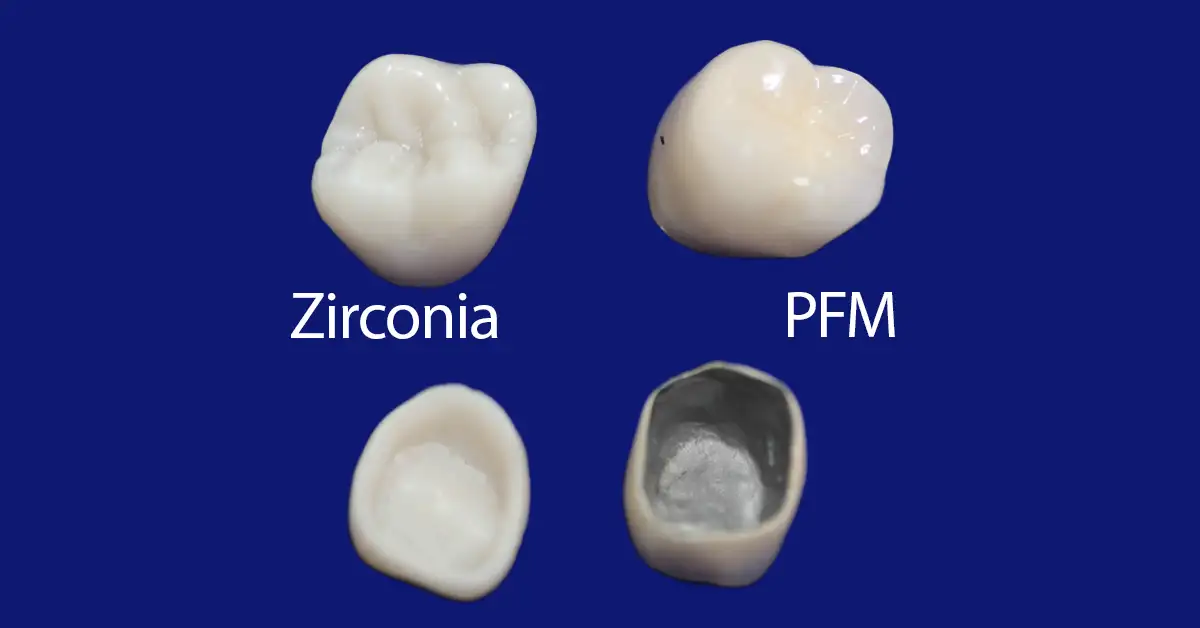 Perbedaaan Crown Gigi PFM Dengan Crown Gigi Zirconia