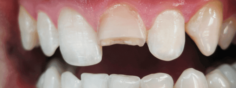 Veneer Gigi Veneer Gigi