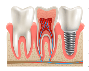 Implan Gigi - LP 2024