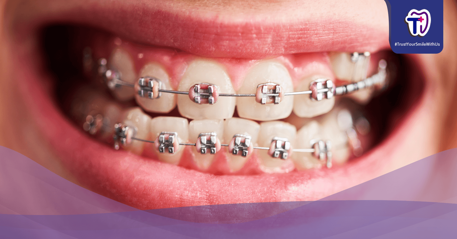 Perawatan Behel Gigi Jadi Sia-sia Jika Abaikan 8 Hal Ini