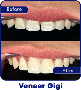 Veneer Gigi