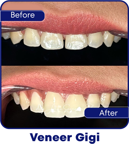 Veneer Gigi