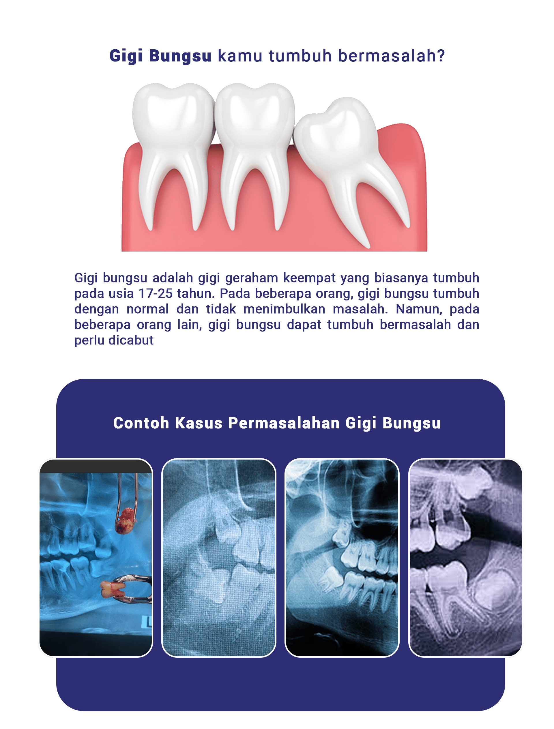 Gigi Bungsu - LP 2024