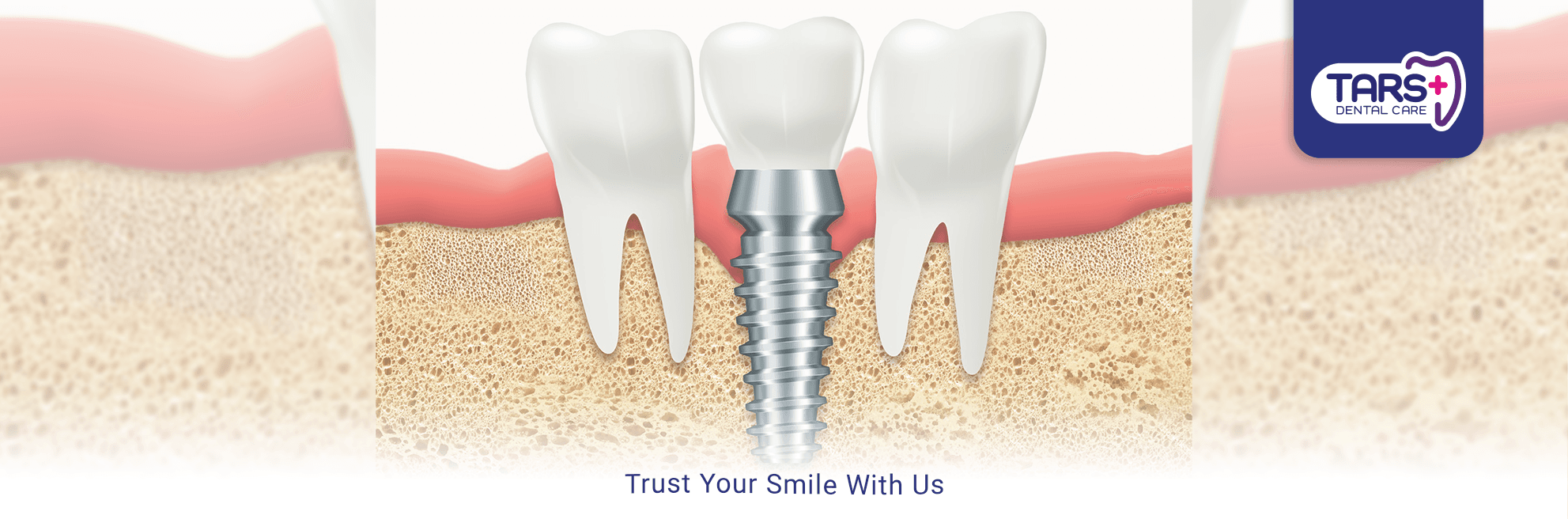 Implan Gigi - LP 2024