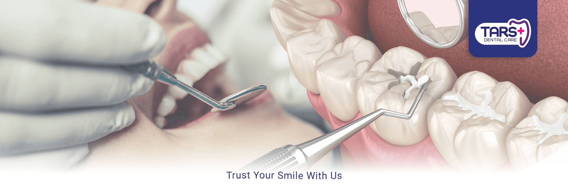 Tambal Gigi - LP 2024