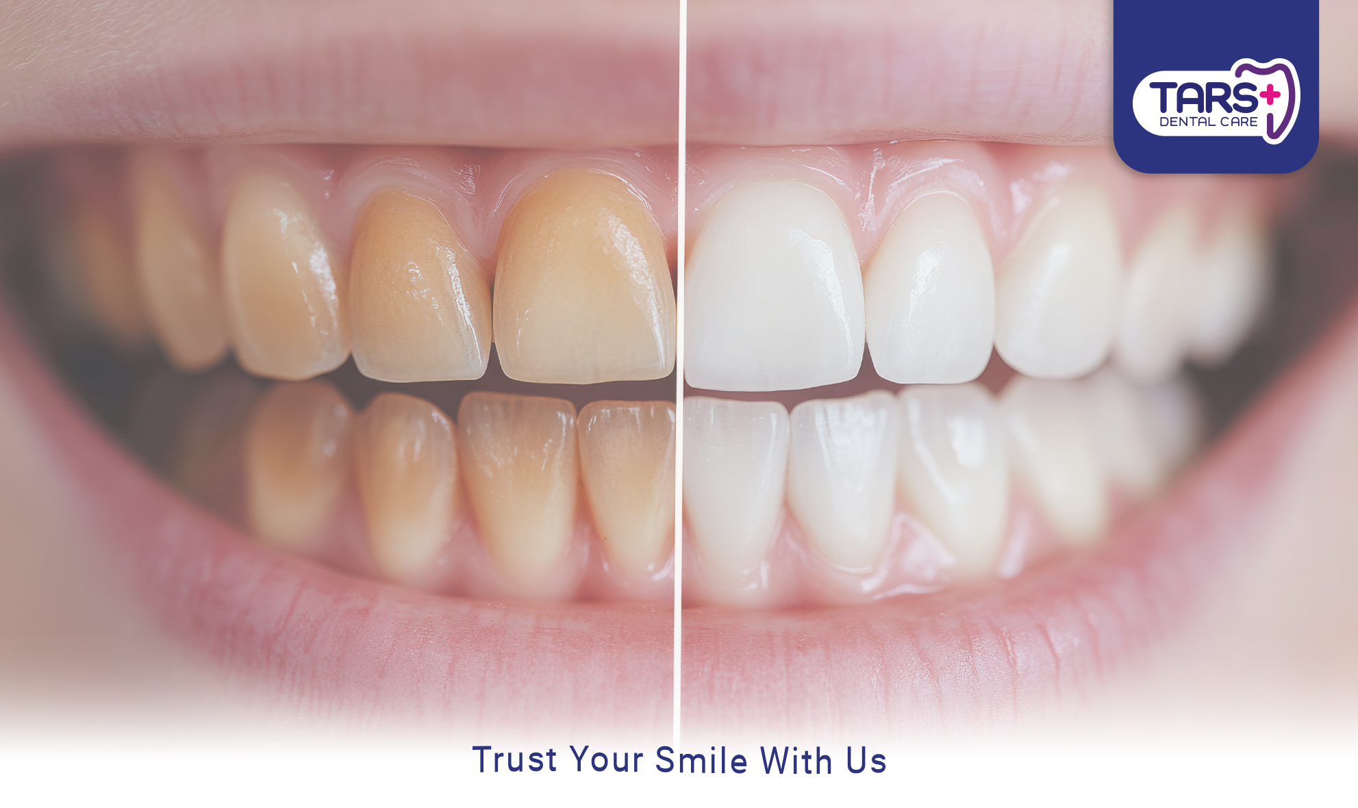 Bleaching Gigi - LP 2024