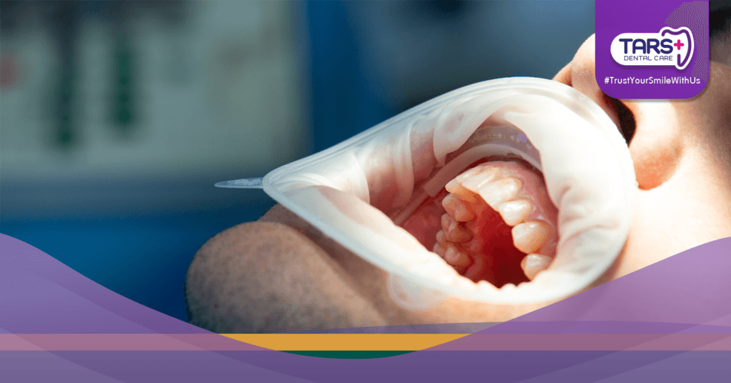 Benarkah Karang Gigi Bikin Bau Mulut Lebih Parah