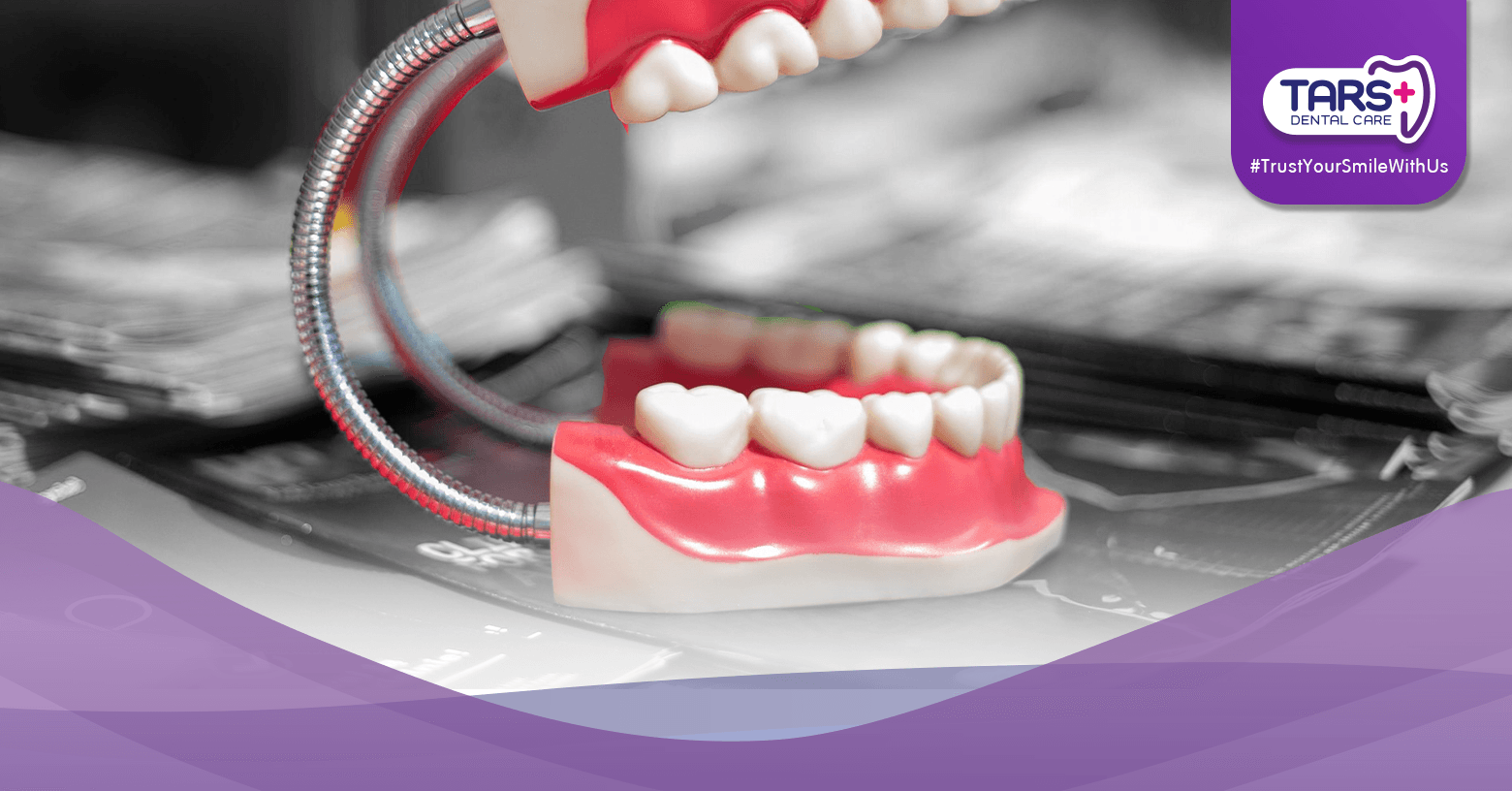 Cabut Gigi Bungsu Sekaligus atau Satu-satu_ Ini Saran Dokter!