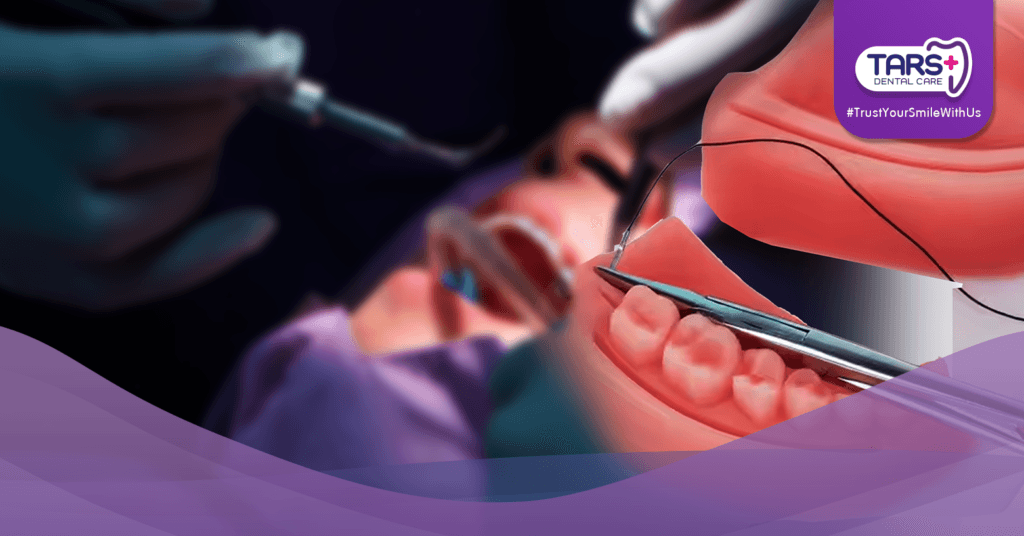 Cabut Gigi Bungsu Tanpa Jahitan vs Pakai Jahitan,