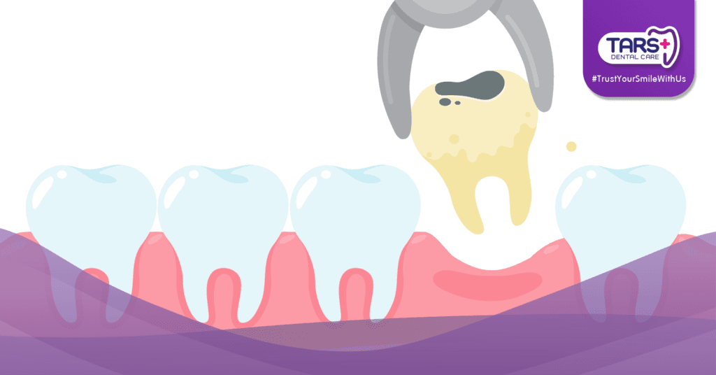 Biaya Cabut Gigi: Panduan Lengkap untuk Pasien di Klinik Gigi