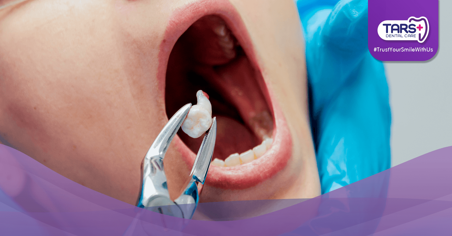 Cabut Gigi: Kapan Perlu & Apa Risikonya?