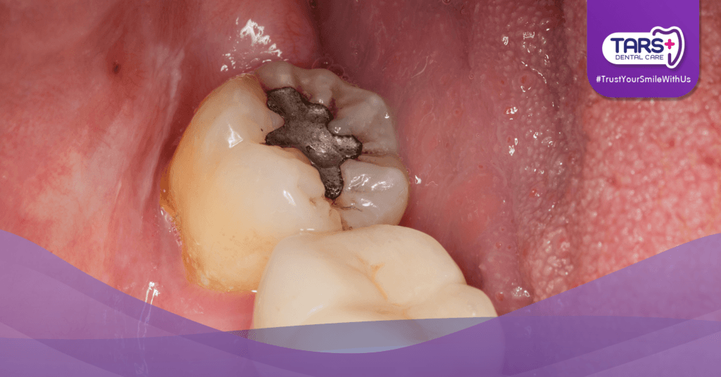 Gigi Berlubang? Jangan Tunggu Parah, Segera Tambal!