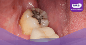 Gigi Berlubang? Jangan Tunggu Parah, Segera Tambal!