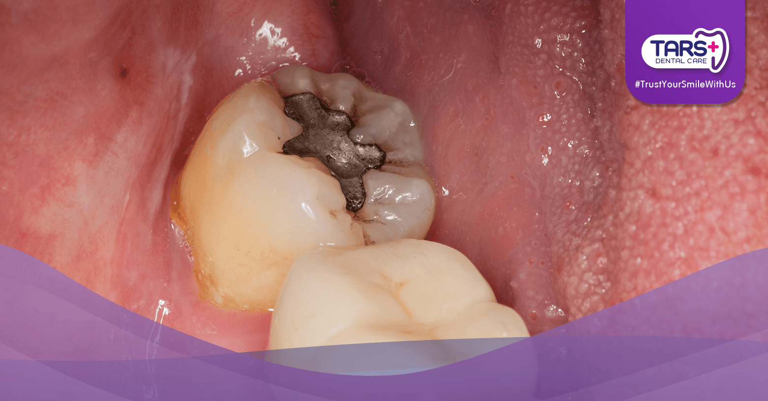 Gigi Berlubang? Jangan Tunggu Parah, Segera Tambal!