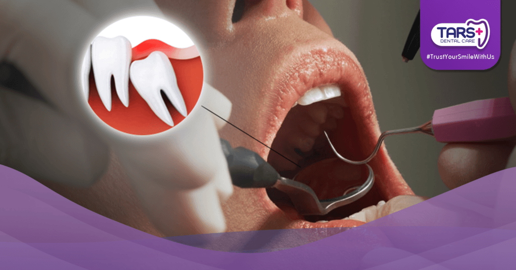 Gigi Bungsu Tumbuh Miring