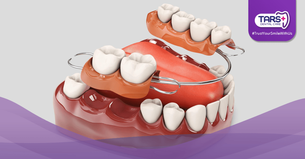 Gigi Tiruan Lepasan vs Permanen: Mana yang Paling Cocok untuk Kamu?