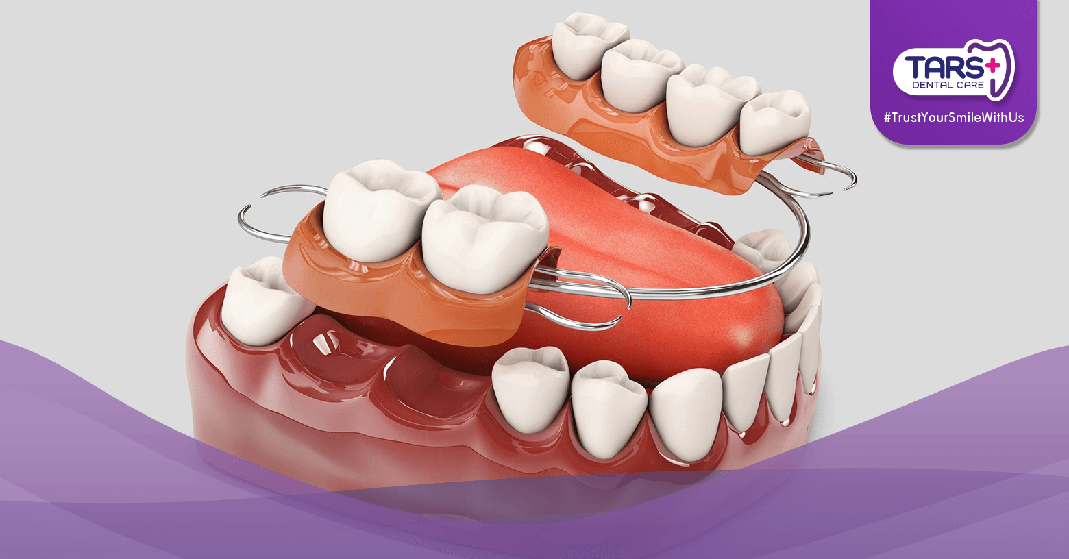 Gigi Tiruan Lepasan vs Permanen: Mana yang Paling Cocok untuk Kamu?