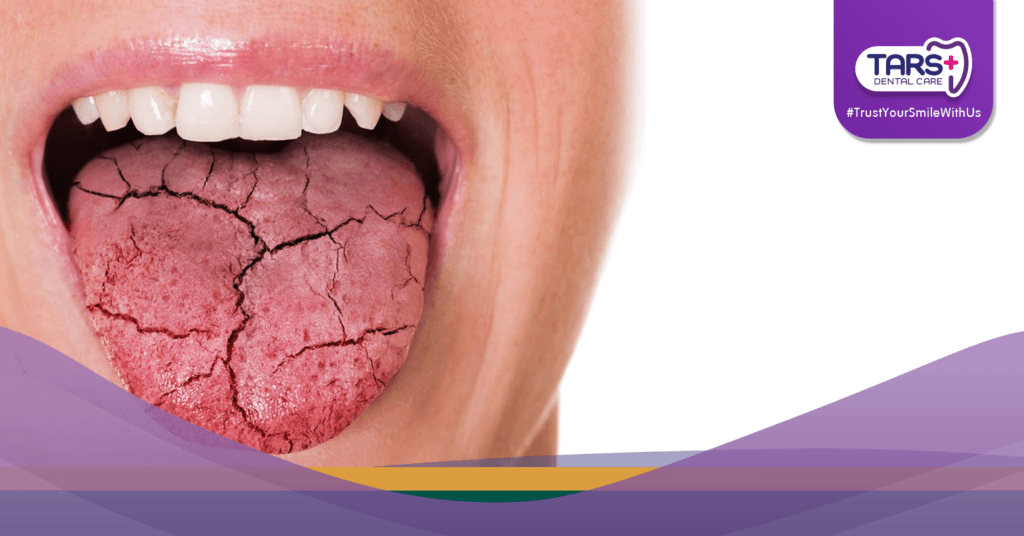 Kenapa Mulut Kering Saat Puasa_ Ini Cara Mengatasinya!