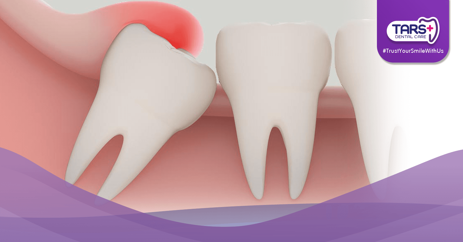 Sakit Gigi Bungsu Harus Dicabut atau Bisa Sembuh Sendiri?