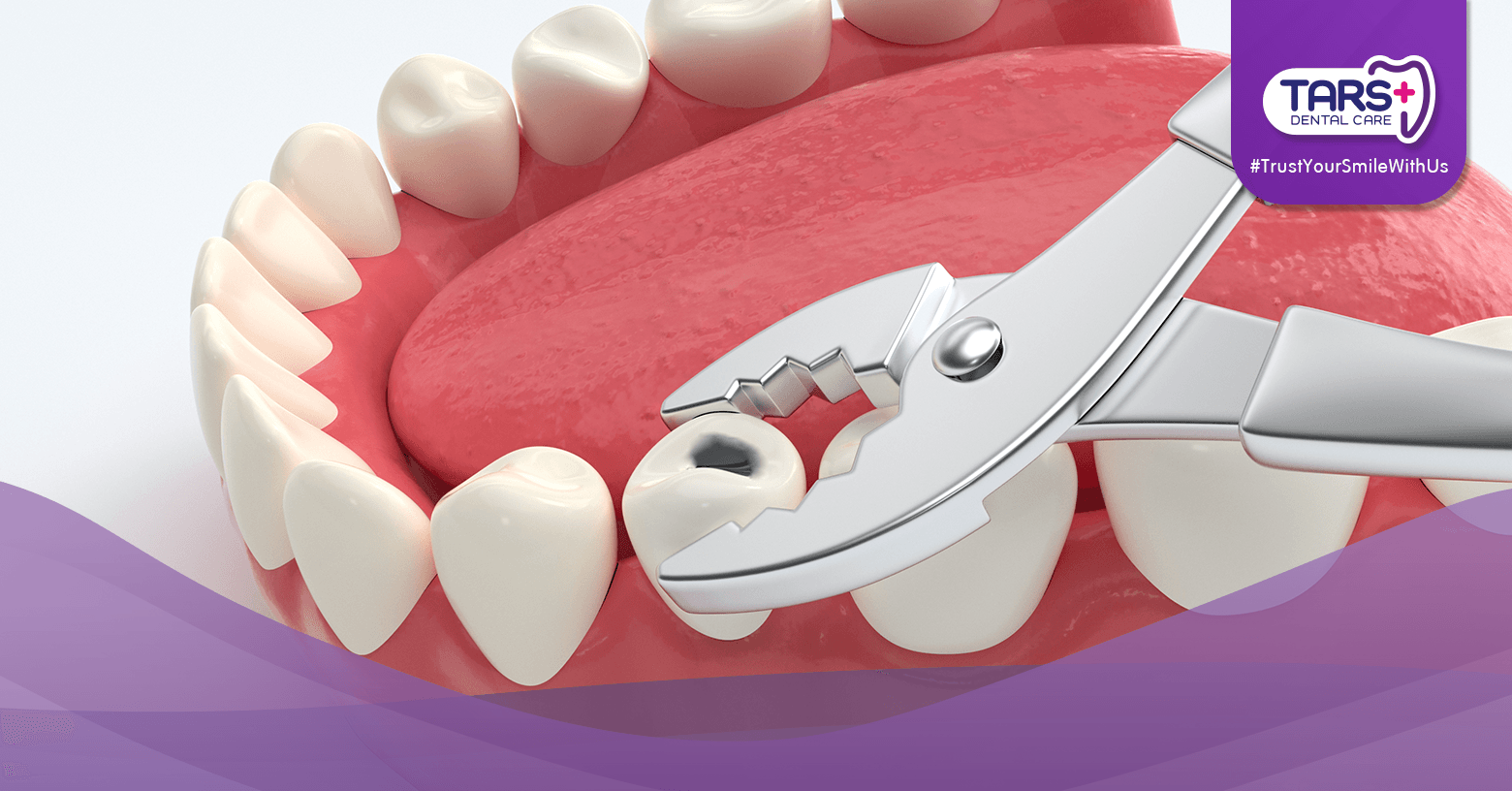 Setelah Cabut Gigi, Bolehkah Langsung Makan?