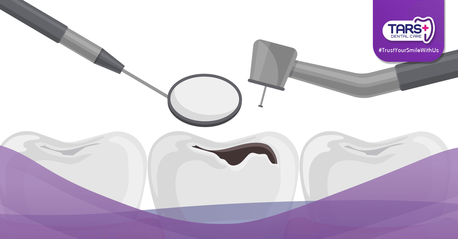 Setelah Tambal Gigi, Bolehkah Langsung Makan? Simak Tipsnya!