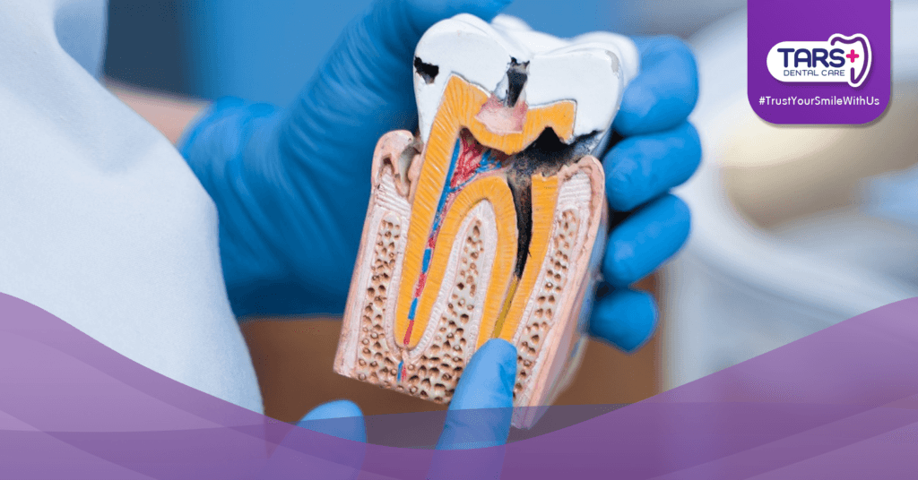 Tambal Gigi: Solusi Cepat Atasi Gigi Berlubang Sebelum Terlambat