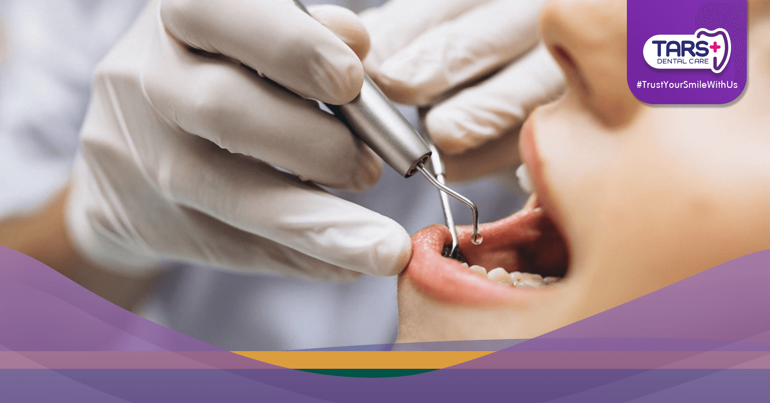 #11 Takut Scaling Gigi Bikin Puasa Batal Ini Fakta yang Harus Kamu Tahu!