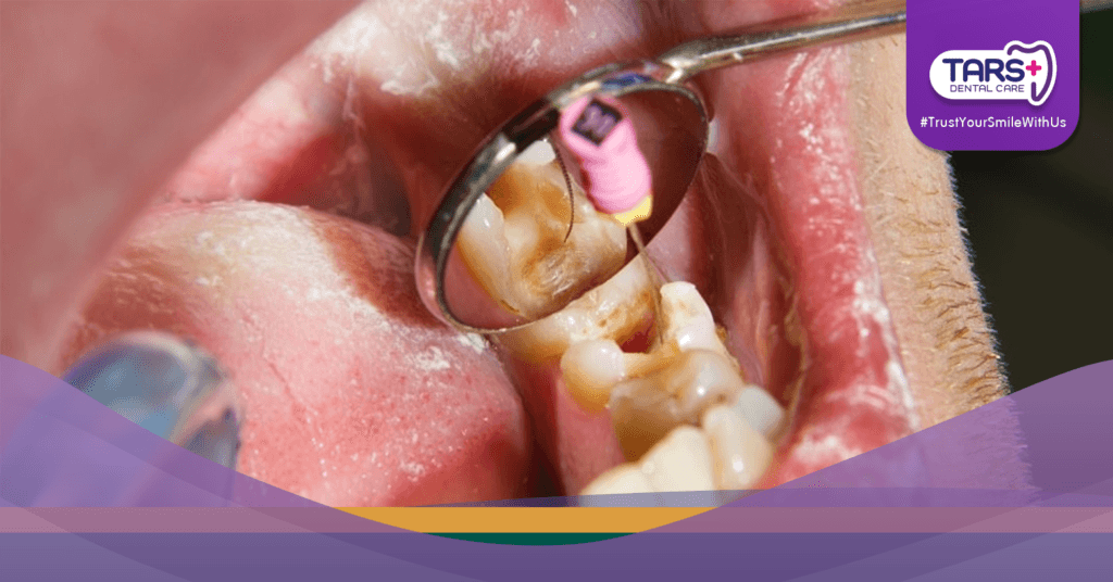 Gigi Berlubang Bisa Sebabkan Kematian Ini Fakta yang Harus Kamu Tahu!