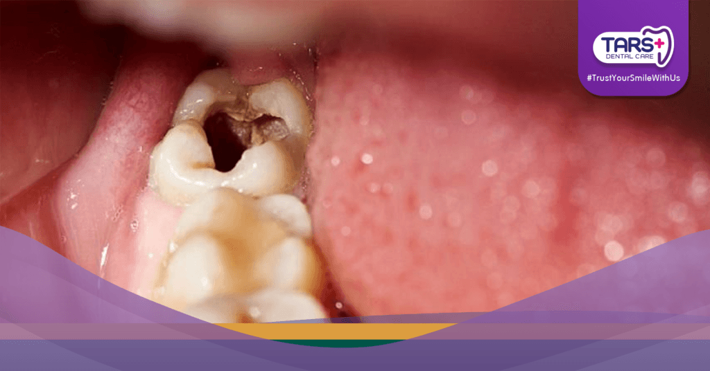 Dikira Hanya Sakit Gigi, Nyawa Melayang Akibat Infeksi!