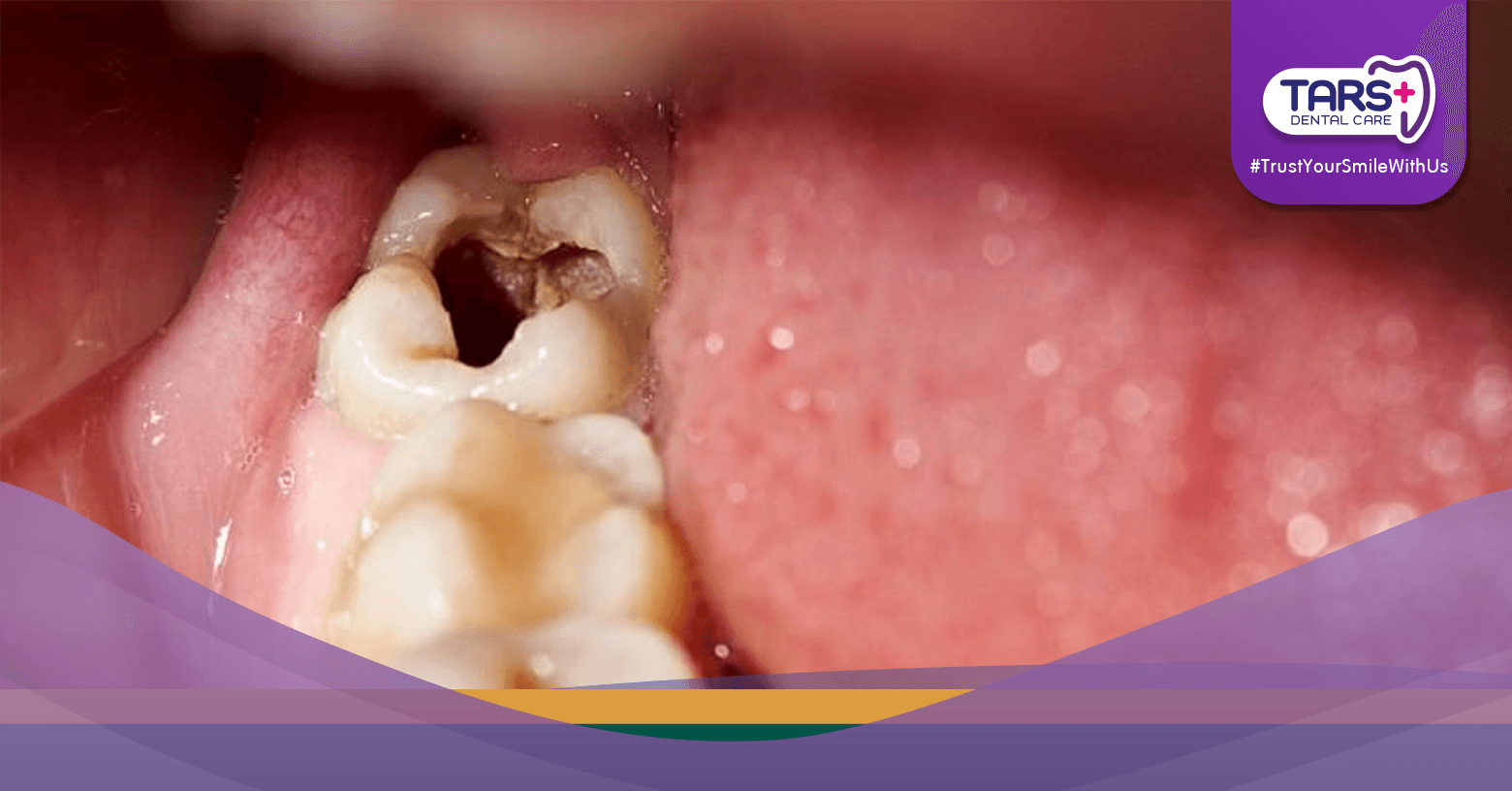 Dikira Hanya Sakit Gigi, Nyawa Melayang Akibat Infeksi!