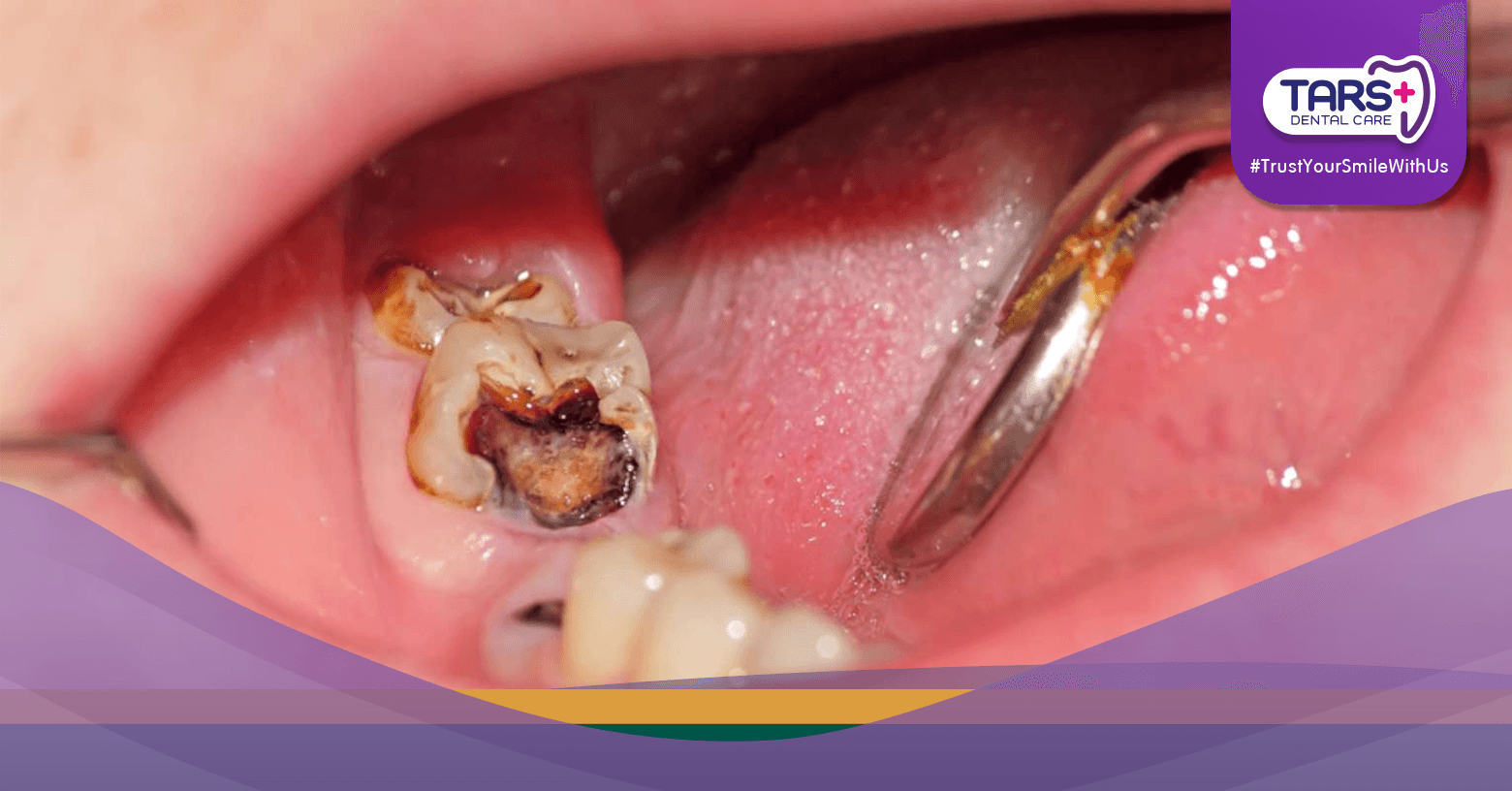 #14 Bukan Cuma Sakit! Ini 5 Komplikasi Berbahaya dari Gigi Berlubang