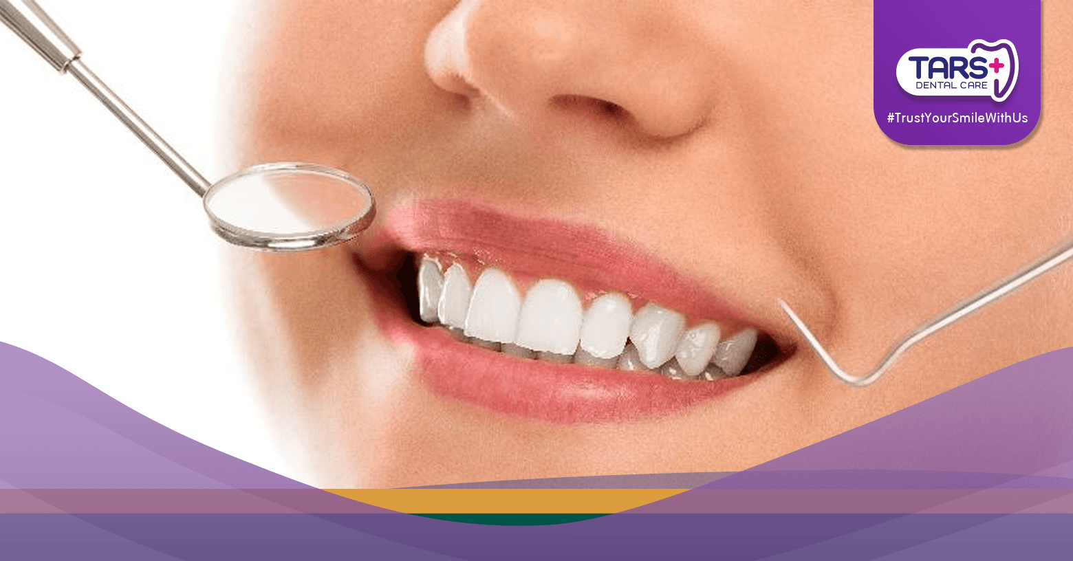 Siapkan Senyum Lebaran! Ini 5 Perawatan Gigi Estetik yang Wajib Dicoba.