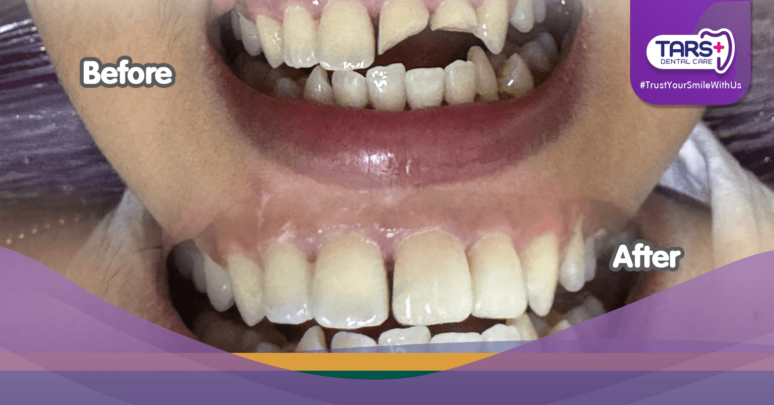 Tambal Gigi Estetik Sebelum Lebaran Biar Senyum Makin Percaya Diri!