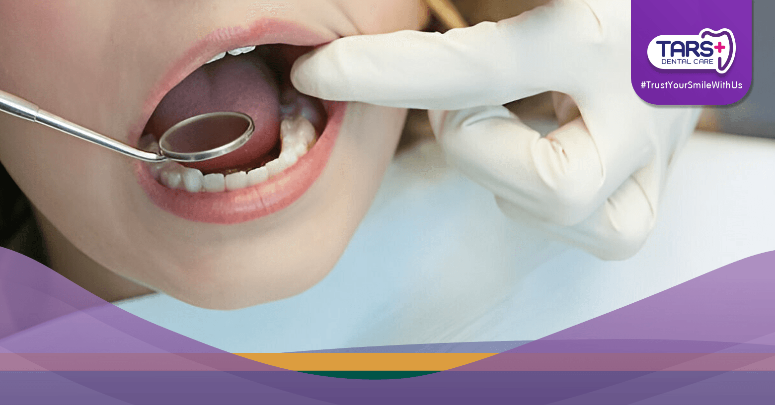 Perawatan Gigi Kilat Sebelum Lebaran Bisa Putih dan Rapi dalam Hitungan Hari