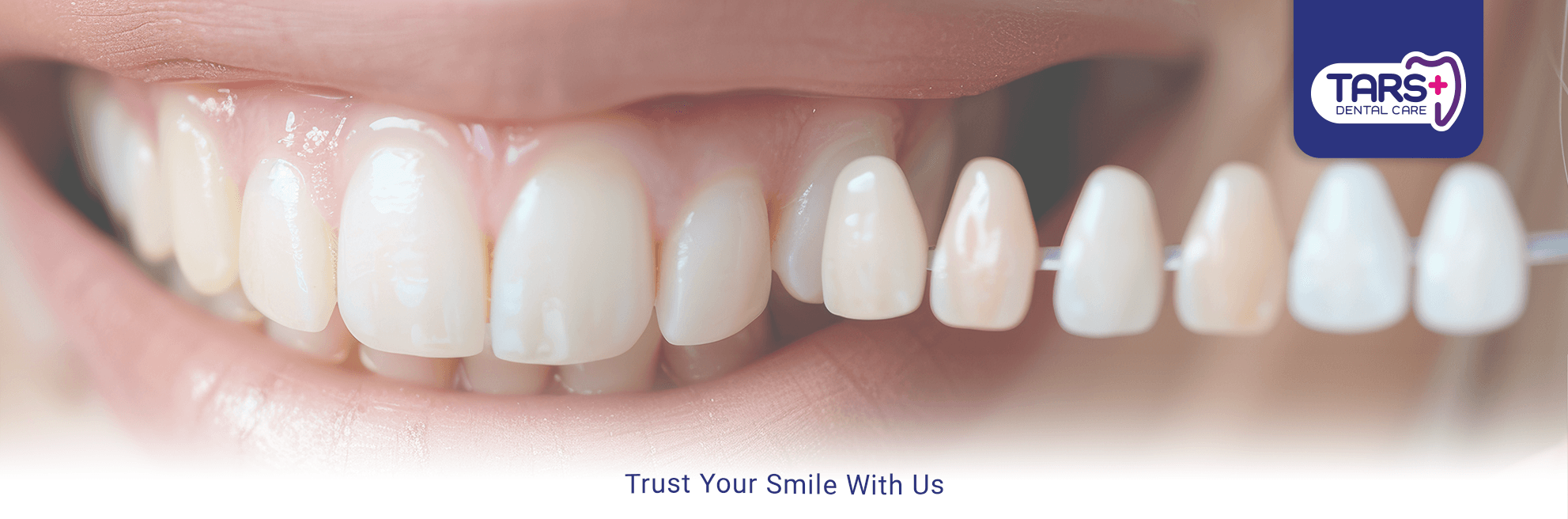 Veneer Gigi - LP 2024 Veneer Gigi - LP 2024