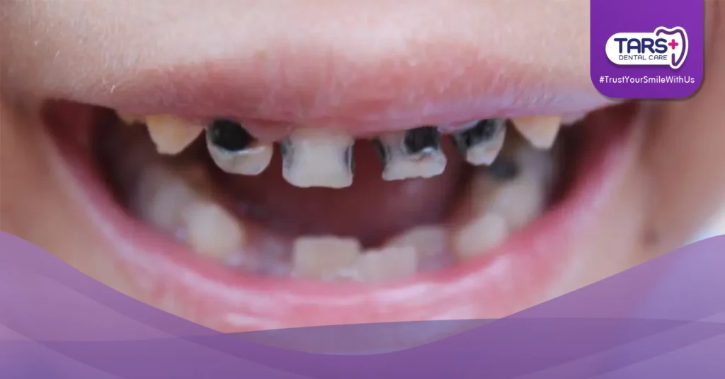 Kebiasaan Buruk Gigi Anak: Awas! Ini 5 Kebiasaan yang Bisa Bikin Gigi Anak Cepat Rusak