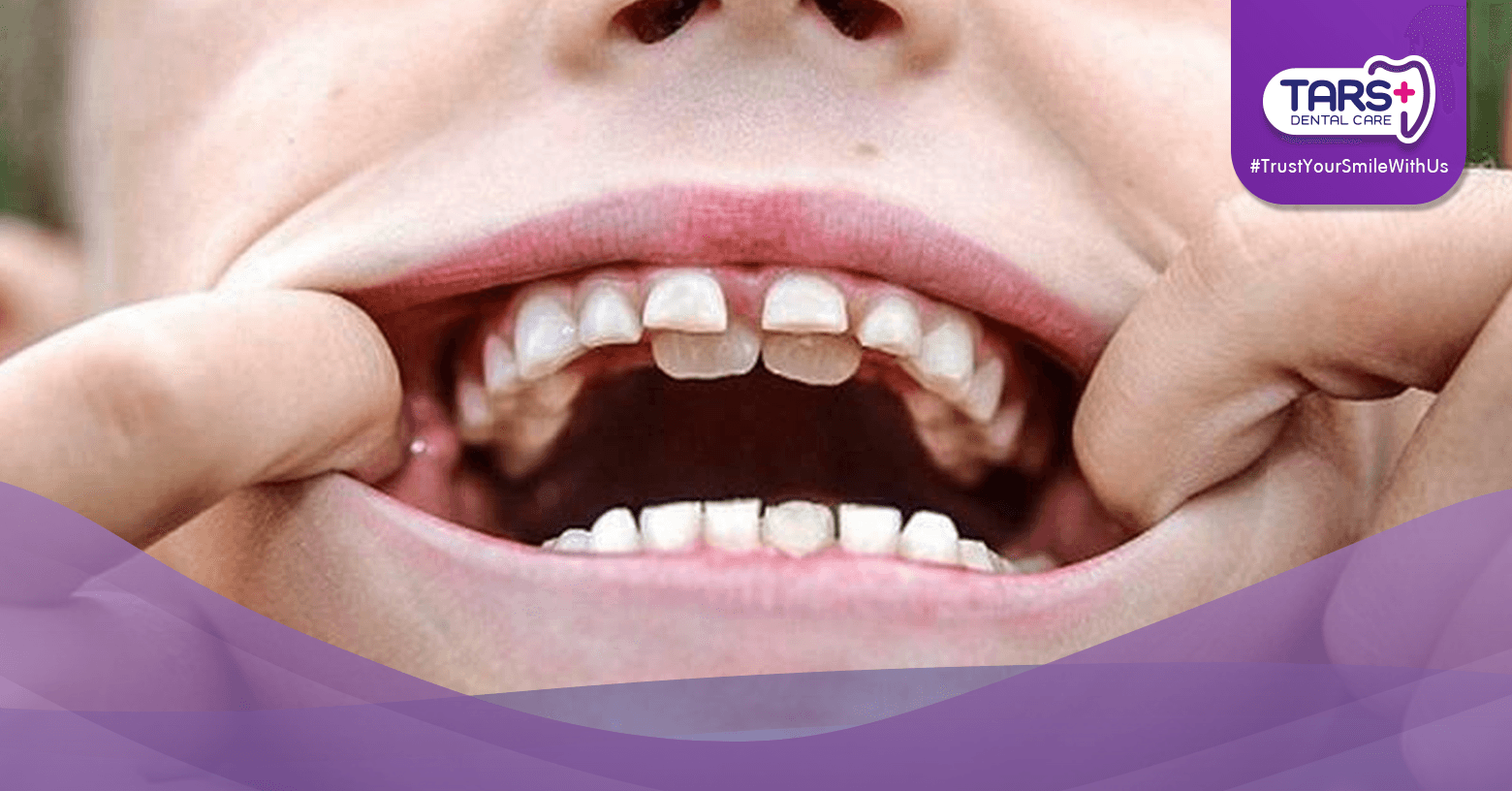 Gigi Anak Bertumpuk: Penyebab, Bahaya, dan Solusi yang Perlu Orang Tua Ketahui