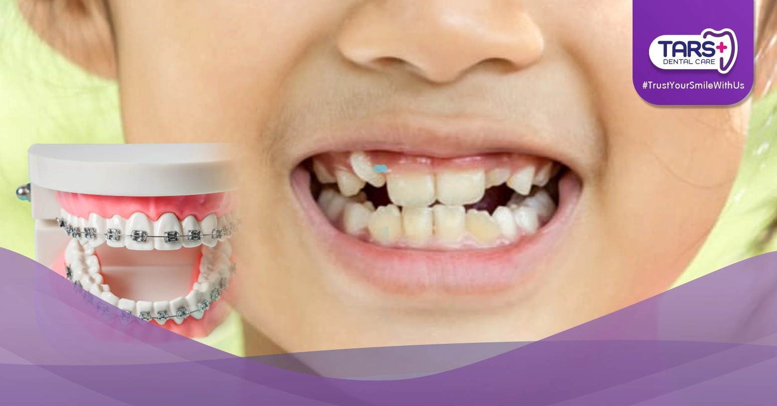 Bolehkah Anak Pakai Behel? Kapan Waktu yang Tepat dan Apa Saja yang Perlu Diketahui