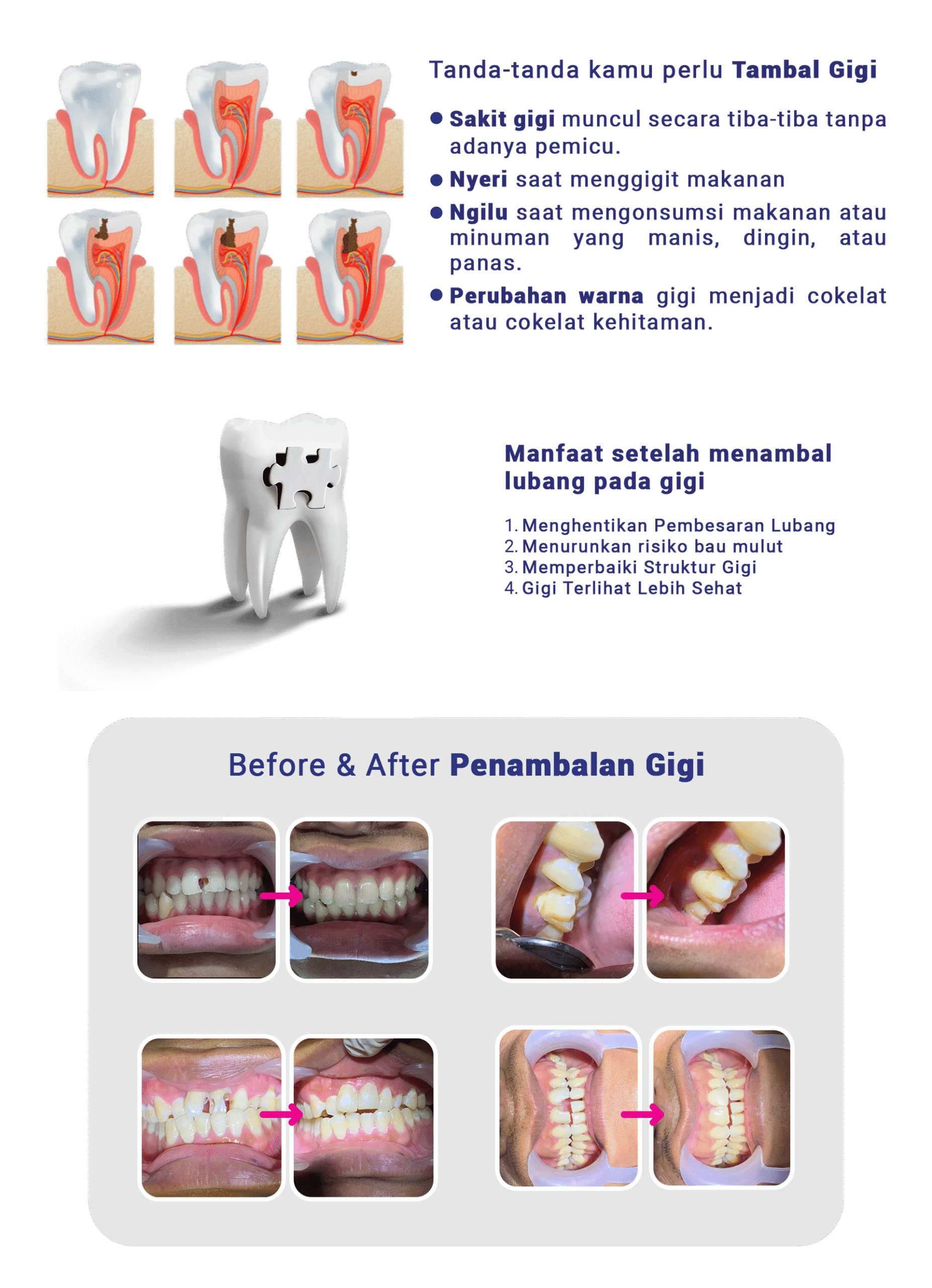 Tambal Gigi - LP 2024