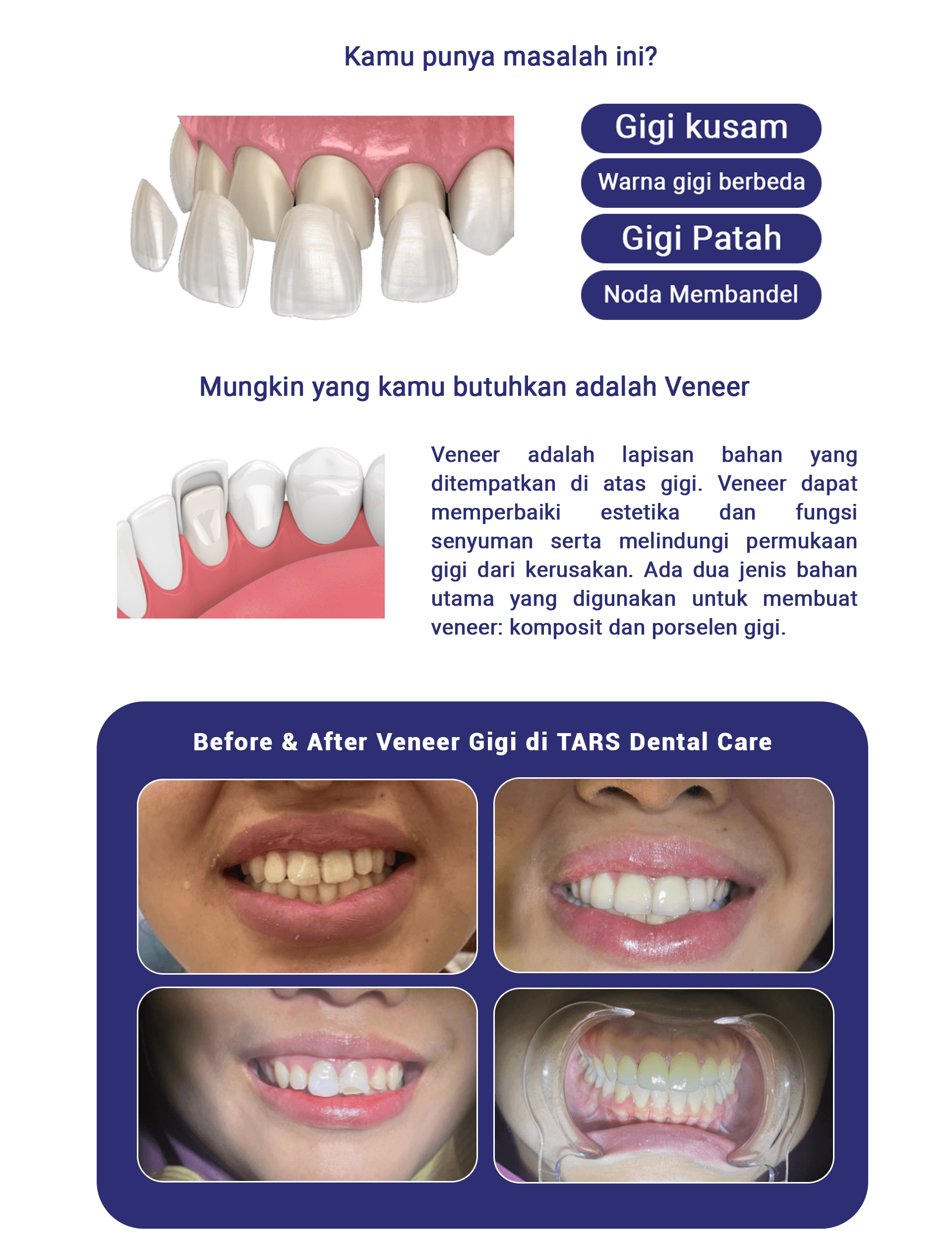 Veneer Gigi - LP 2024 Veneer Gigi - LP 2024