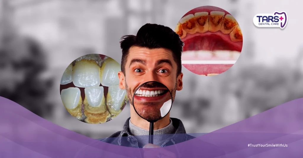 Perbedaan Stain dan Karang Gigi: Cara Cepat Hilangkan Noda Gigi