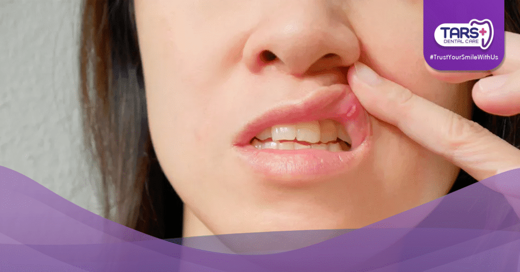 Sering Sariawan? Bisa Jadi Tanda Penyakit Serius!