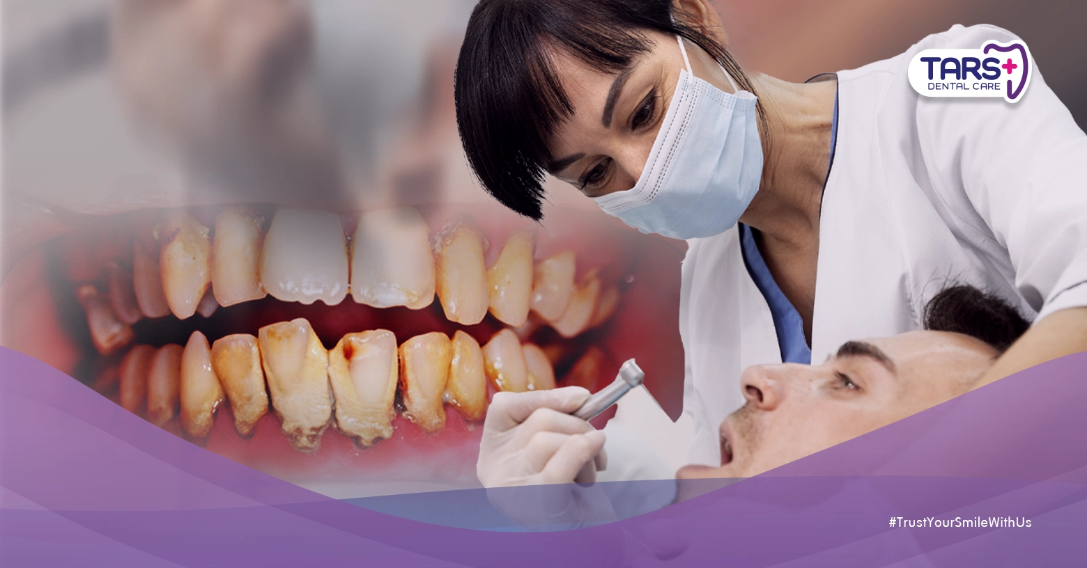 Stain dan Karang Gigi: Penyebab, Gejala, dan Perawatannya